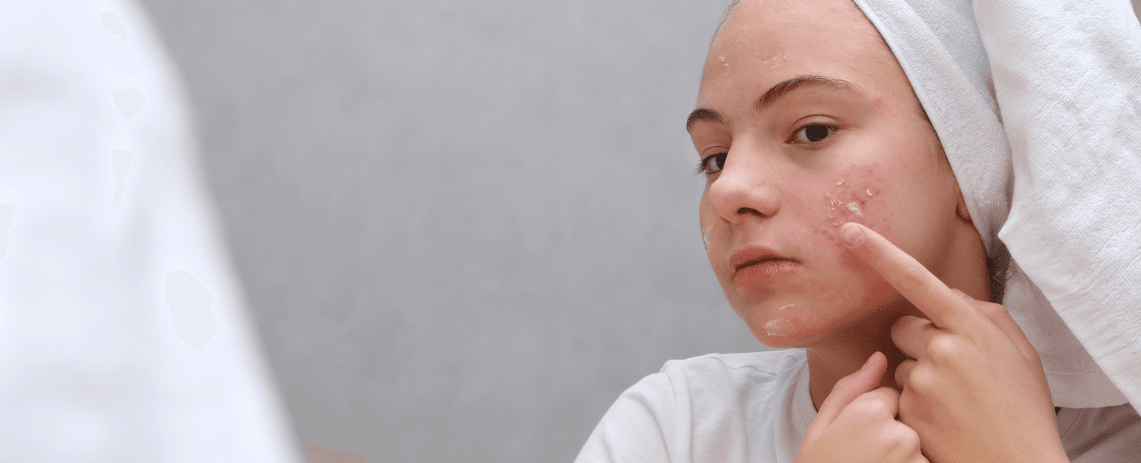 Normalizáló, nyugtató kezelés, aknés gyulladt bőrre