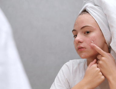 Normalizáló, nyugtató kezelés, aknés gyulladt bőrre