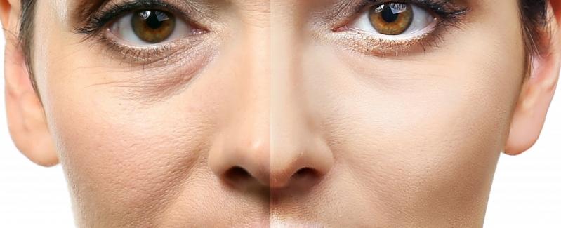 Anti-aging kezelés, 45+, érett, idősödő bőrre